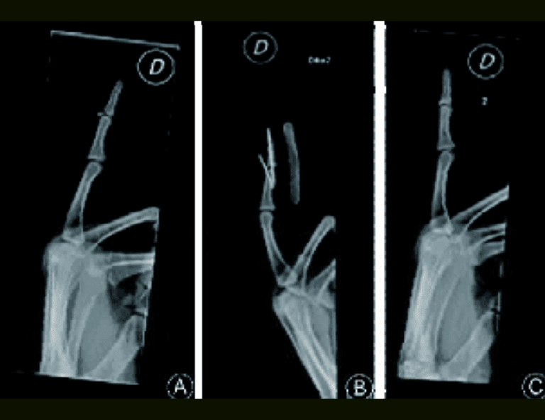 radiografía de fractura de dedo en martillo
