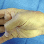 el paciente demuestra movimiento 3 semanas después de la operación de sustitución del pulgar