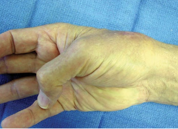 patient demonstrates motion 3 weeks post op thumb replacement