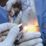 artroscopia de articulaciones pequeñas