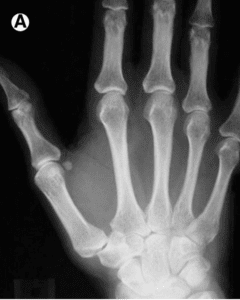xray of arthritic thumb