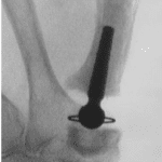 comprobación de la estabilidad de los implantes mediante fluoroscopia