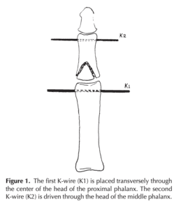 Fijación externa dinámica intradigital para las luxaciones de fracturas de la articulación interfalángica proximal