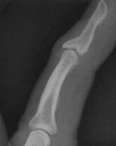 Radiografía del dedo en martillo