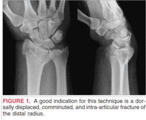 Distal radius fracture ap and lateral view xray