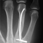 pinning of metacarpal fracture