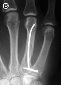 pinning of metacarpal fracture