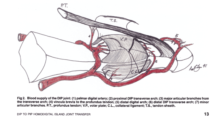 proximal interphalangeal joint homodigital island transfer