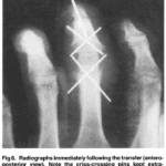 radiografía de los dedos