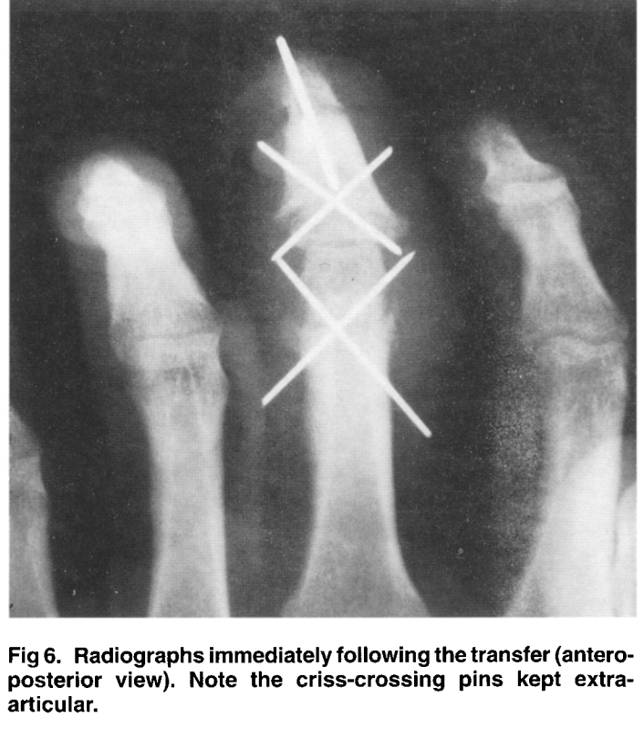 radiografía de los dedos