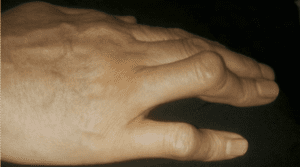 deformidad de la boutonniere causada por artritis reumatoide inflamación de la articulación