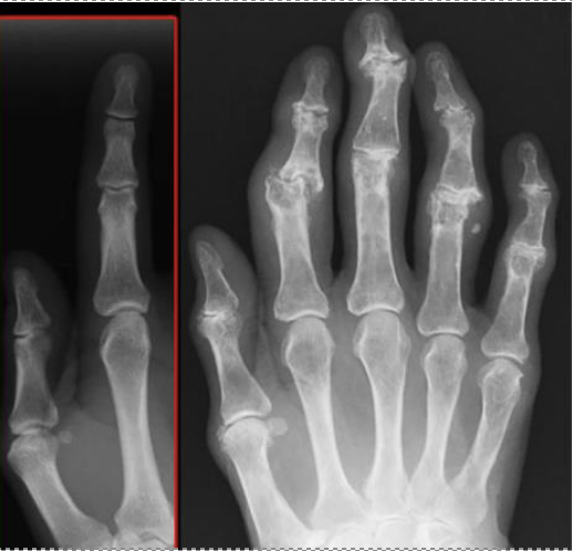 artritis reumatoide radiografía de la mano