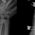 xray of wrist fracture