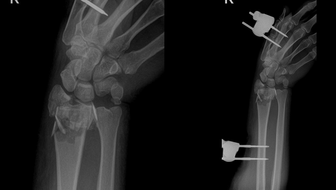 comminuted displaced intra articular distal radius fracture icd 10