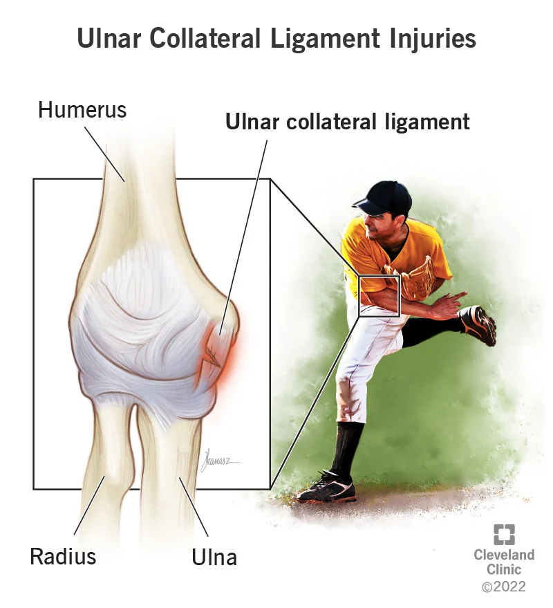 -ulnar-collateral-ligament-injuries in baseball
