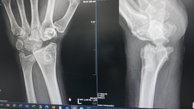 wrist xray before total wrist replacement