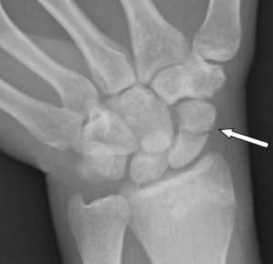 OrthoNOW: Scaphoid Fracture | DrBadia.com