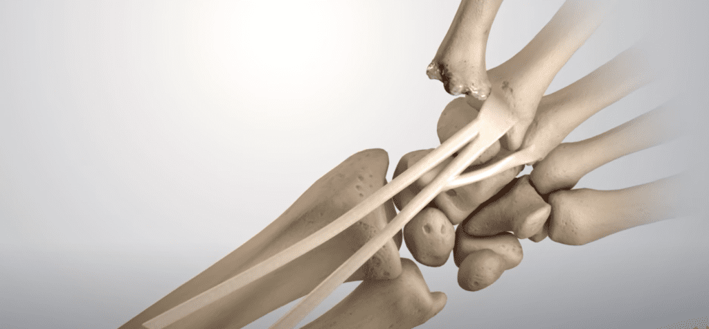 procedimiento lrti para la artritis de la articulación basal