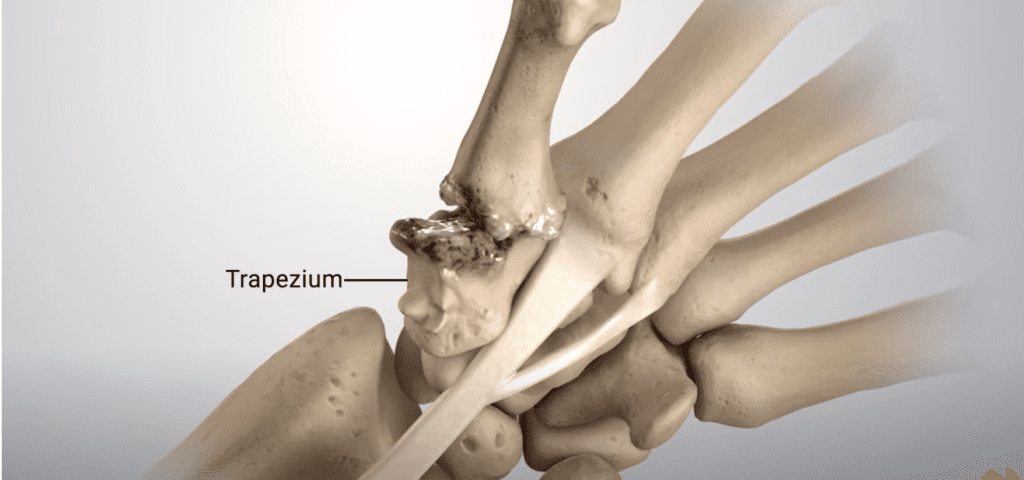arthritic trapezium basal joint arthritis