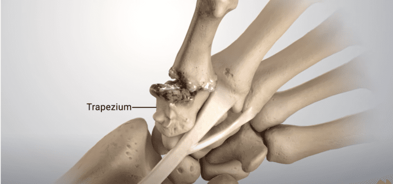 artritis artrítica de la articulación basal del trapecio