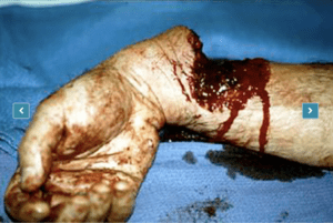 Circular saw near amputation