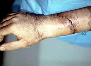 after Circular saw near amputation