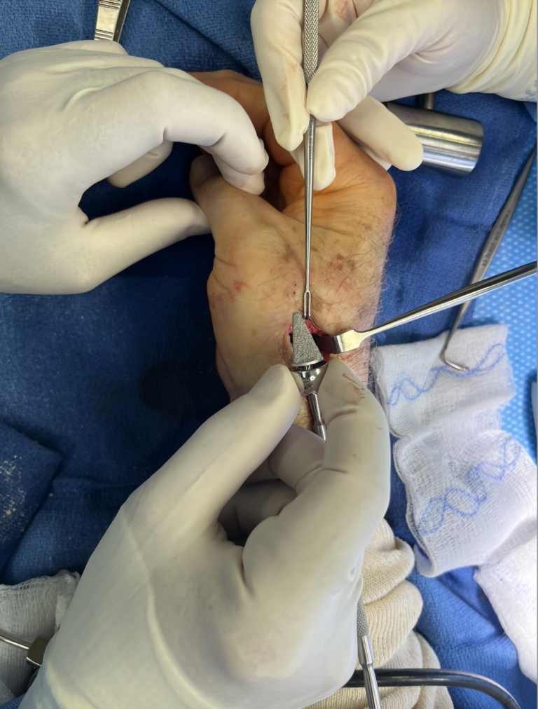 Biopro implant in the operating room