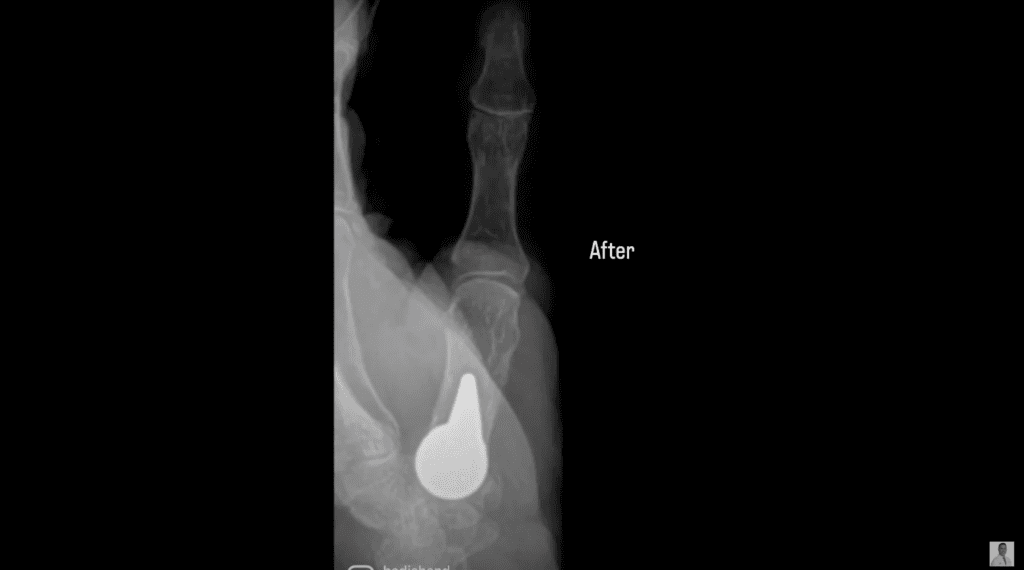 Biopro modular implant for base of the thumb arthritis - Impressive before and after xray!