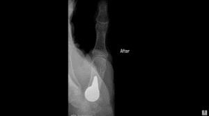 Implante modular Biopro para la artrosis de la base del pulgar - ¡Impresionante radiografía del antes y el después!