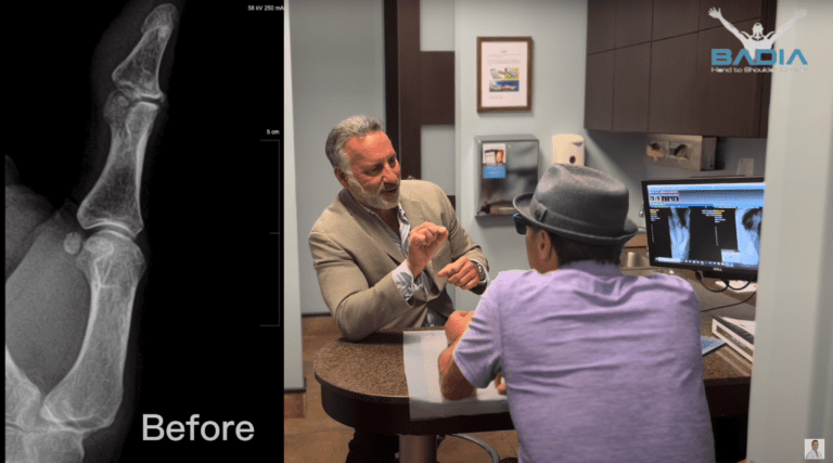 Patient finds a solution for severe thumb pain after years of failed conservative treatment