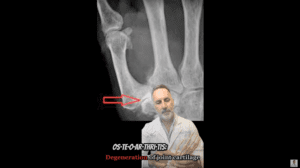 Dr. Badia explains Basal joint arthritis (Thumb Pain)