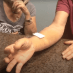 Un paciente empieza a usar la mano tras una artroplastia de pulgar