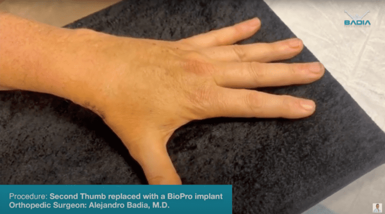 Segundo pulgar sustituido por un implante BioPro