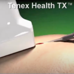 Needle close up showing how tenex procedure works