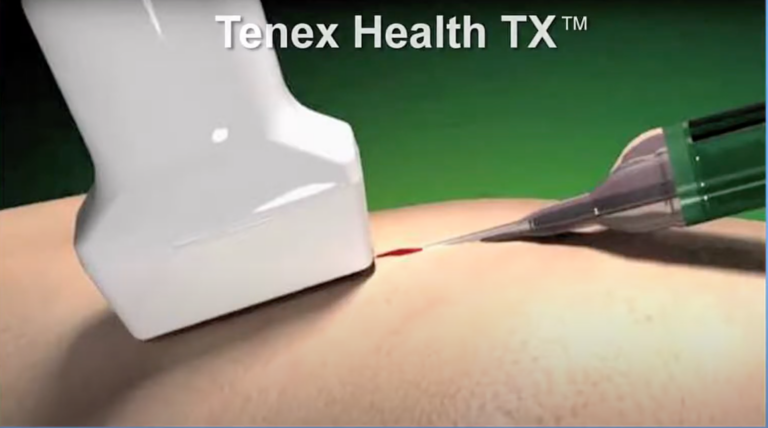 Needle close up showing how tenex procedure works