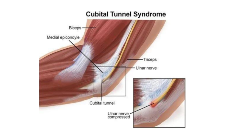 cubital tunnel syndrome.1