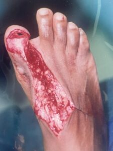 amputación del dedo gordo del pie
