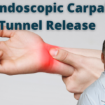 Liberación endoscópica bilateral del túnel carpiano Dr. Badia