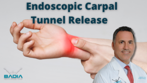 Liberación endoscópica bilateral del túnel carpiano Dr. Badia