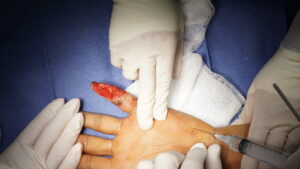 before finger flap by dr. badia