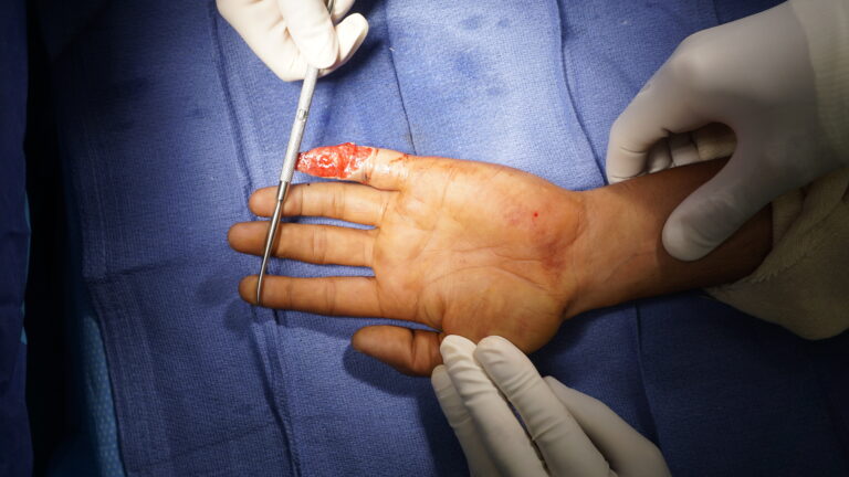 before finger flap by dr. badia patient from trinidad