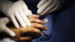 before finger flap by dr. badia