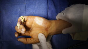 Skin graft area used for finger flap by Dr. Badia