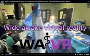 liberación del túnel carpiano en realidad virtual completamente despierto