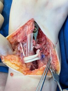 intraop distal radius fracture management