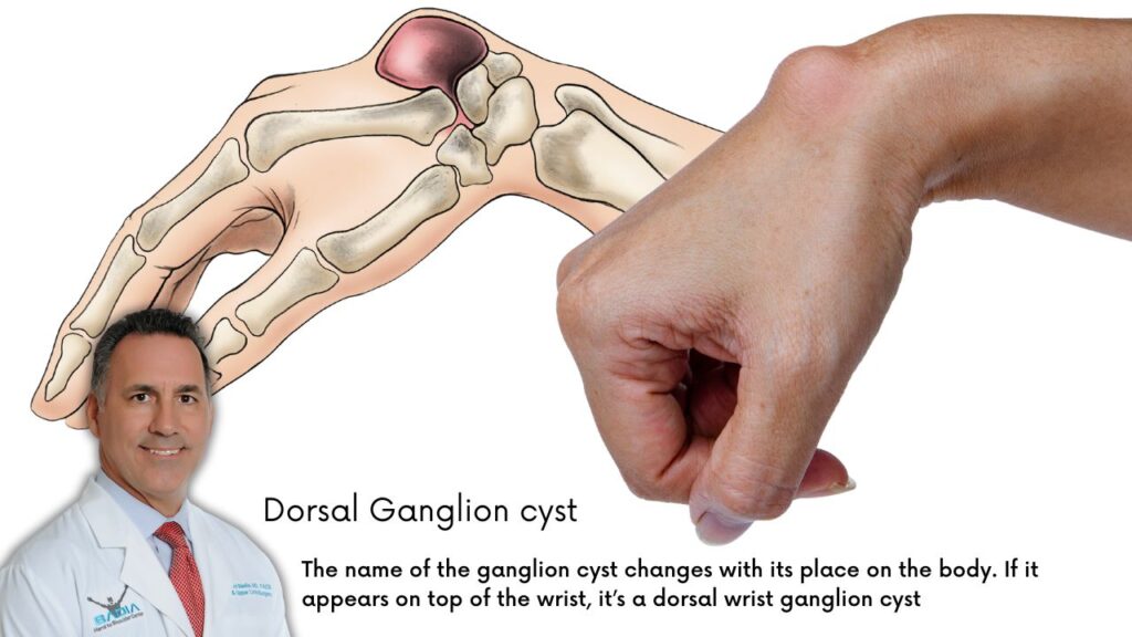 Dorsal ganglion cyst