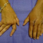 Caso de artritis reumatoide