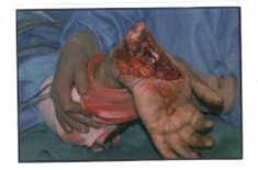 Hand And Wrist Mutilation Due To Truck Tire Explosion 2