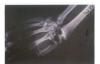 Hand And Wrist Mutilation Due To Truck Tire Explosion xray 1