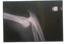 Hand And Wrist Mutilation Due To Truck Tire Explosion xray 2